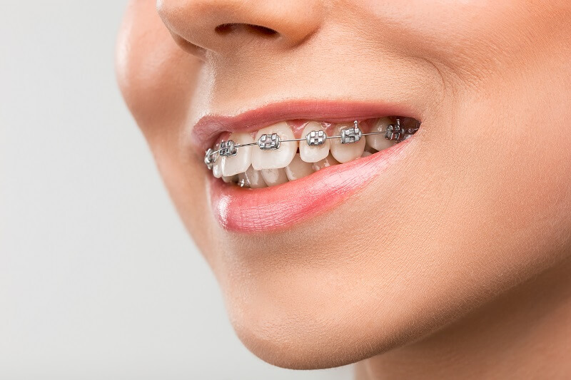 Dental Braces for Adults