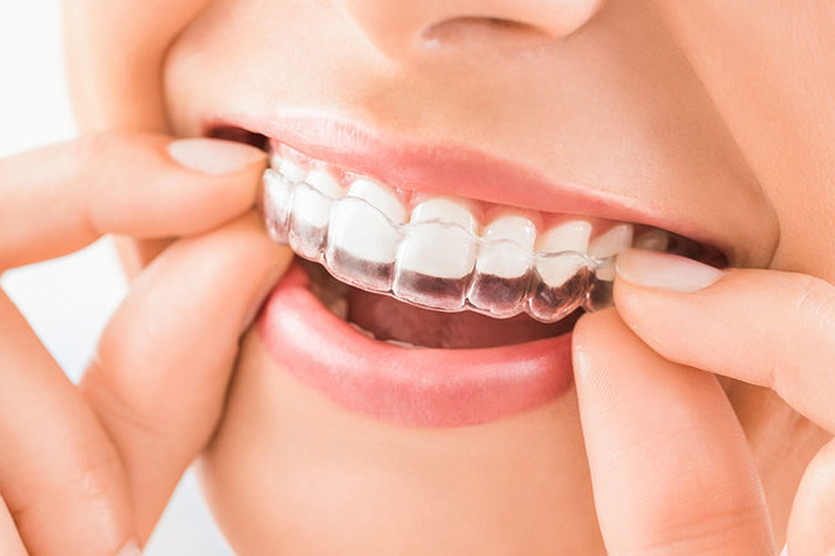 What Are Dental Aligners And How Do Dental Aligners Work?