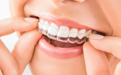 What are Aligners? How Do Aligners Work?