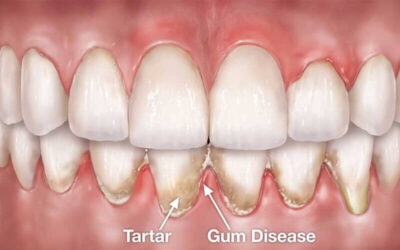 Everything You Should Know About Gum Pockets And Treatment Options