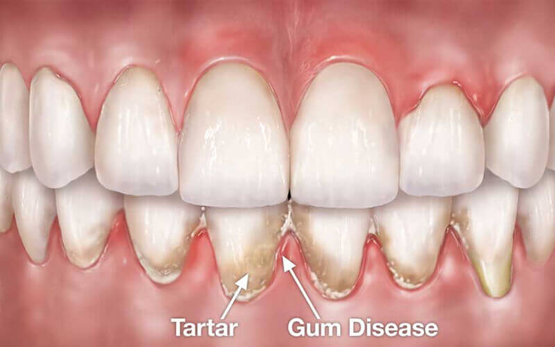 You Should Know About Gum Pockets & Treatment Options