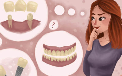 How Much Long Does It Take to Get a Dental Bridge?