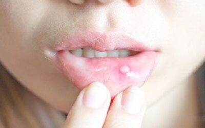 MOUTH SORES: CANKER AND COLD SORES, SYMPTOMS, CAUSES AND TREATMENT