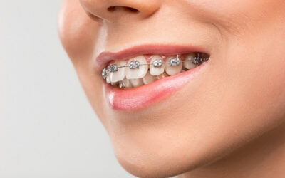 Are Dental Braces an Option for Adults?