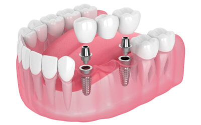 Temporary Tooth And Related Aspects