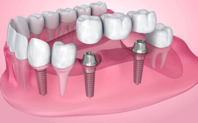 Things To Know Regarding Mini Dental Implants