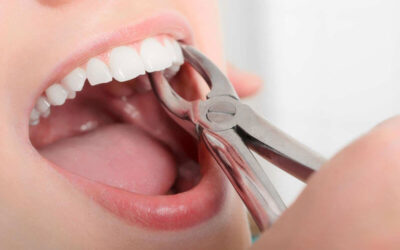 Top Reasons to Get a Tooth Extracted