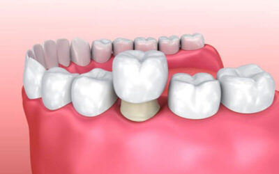 What Does Zirconia Crown Stand For?