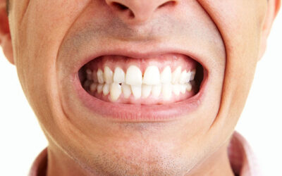 Things to Know About Dentures