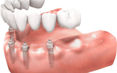 Dental Bridge Aftercare: Tips for a Smooth Recovery
