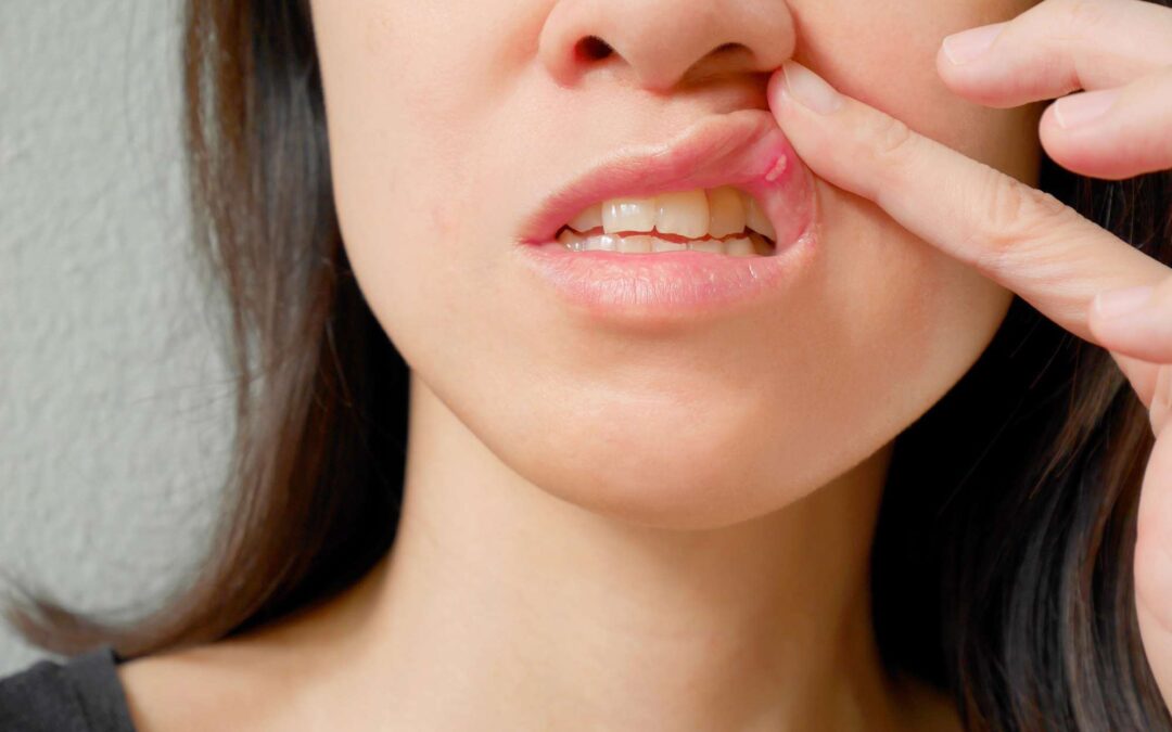 How to Get Rid of Canker Sores?