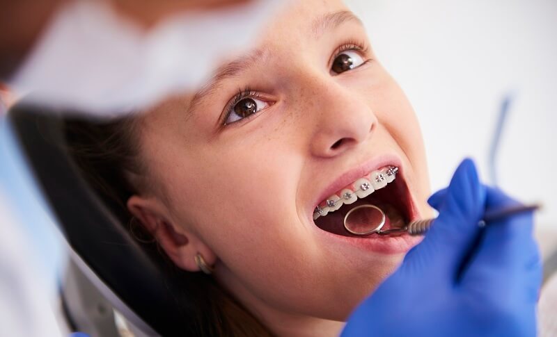 At What Age Should Your Children Get Dental Braces?