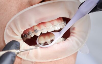 How To Floss A Dental Bridge?