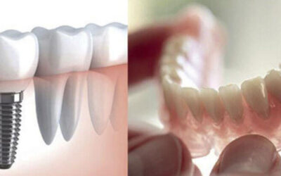Affordable Dentures And Implants-Related Things To Know About