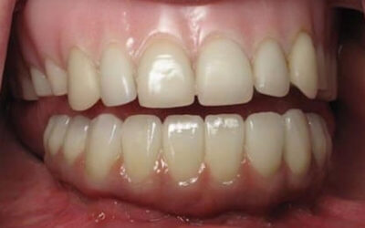 Flipper Tooth -Important Aspects To Have A Look