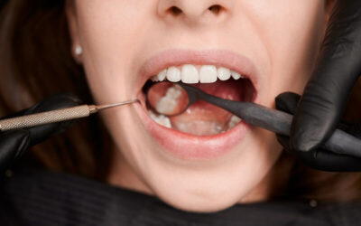 PERIODONTITIS-YOU NEED TO TAKE CARE OF THIS DENTAL DISEASE