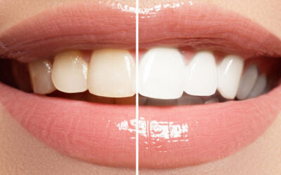 Teeth Whitening and Bleaching-Is It Safe And Effective?