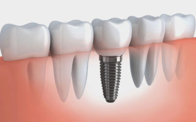 Titanium Dental Implants-Related Information to be Acquainted With