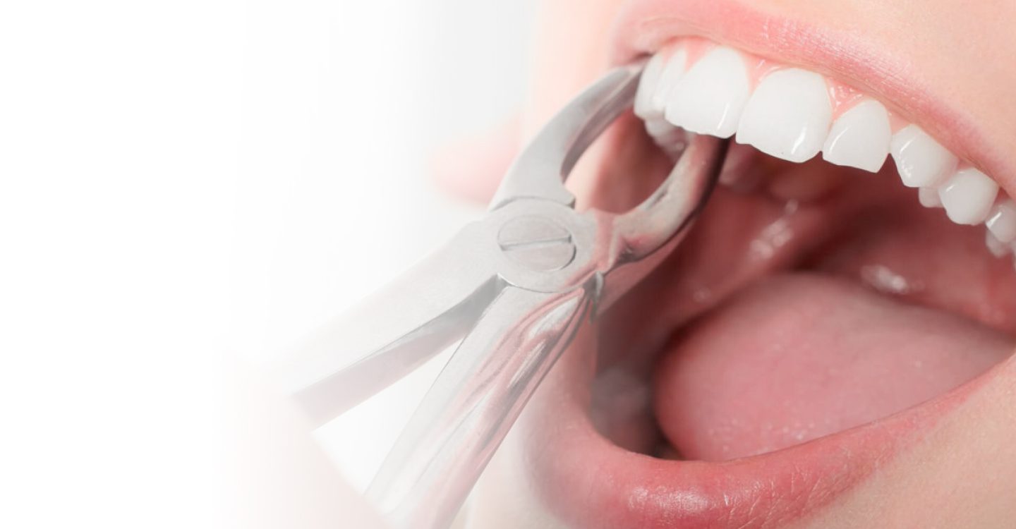 What You Should Know About Tooth Extraction Elite Dental