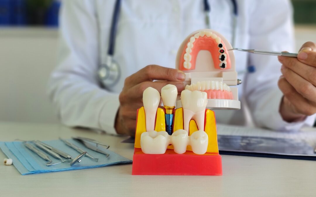 Dental Implants vs. Other Tooth Replacement Options: Which Is Best for You?