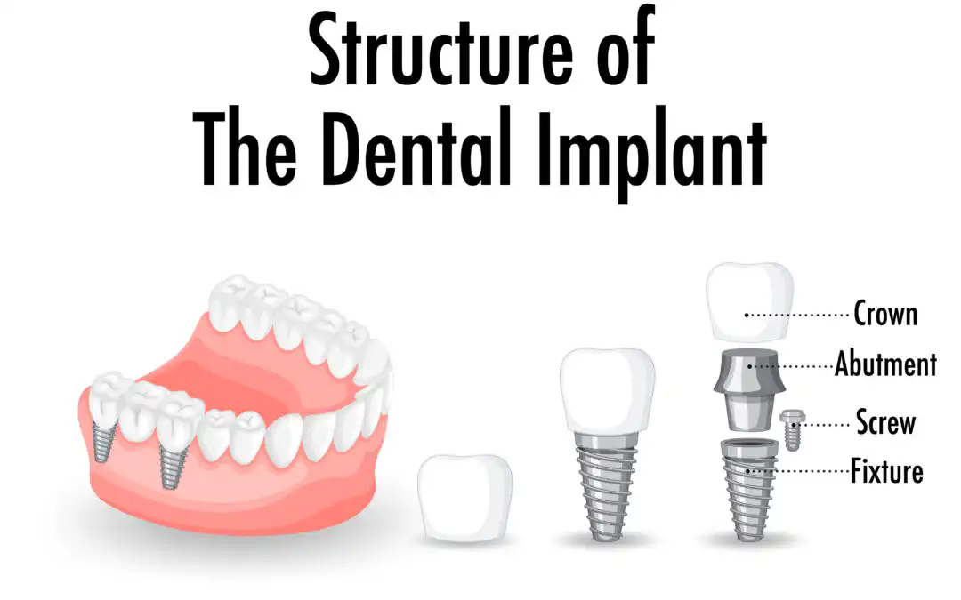 Types of Material Used in Dental Implants