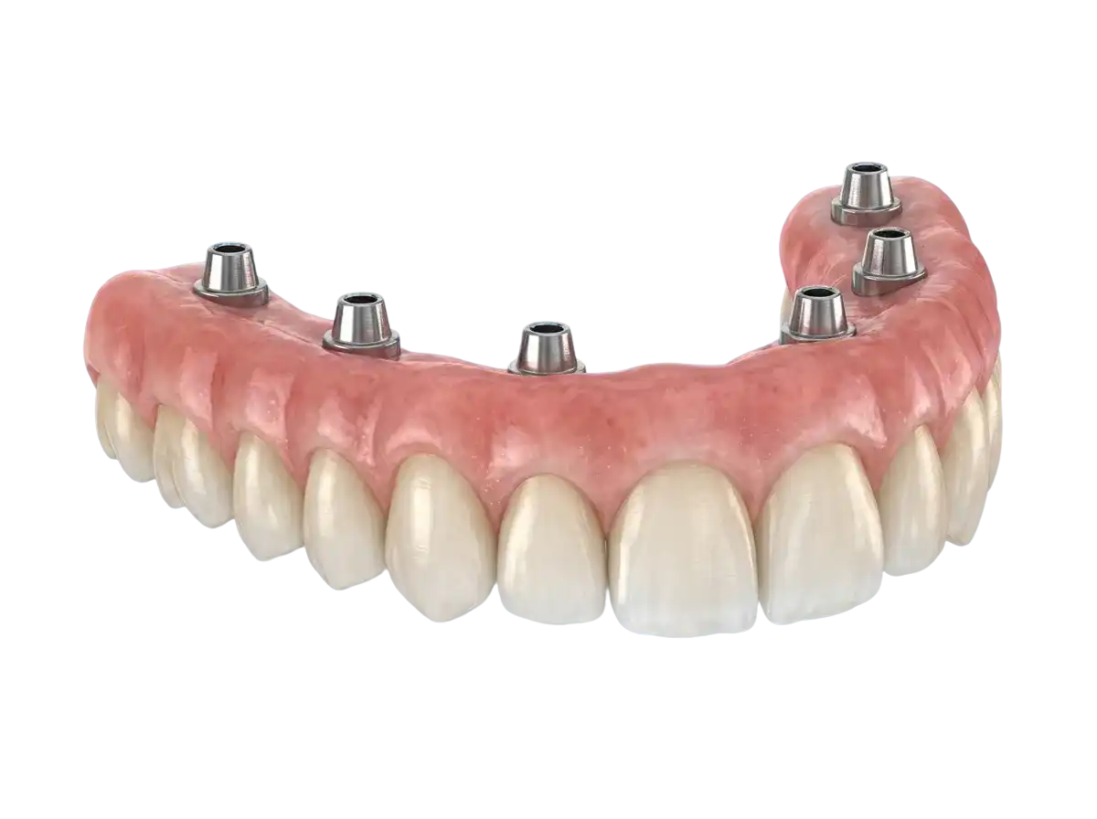 Full-Mouth Zirconia Implants