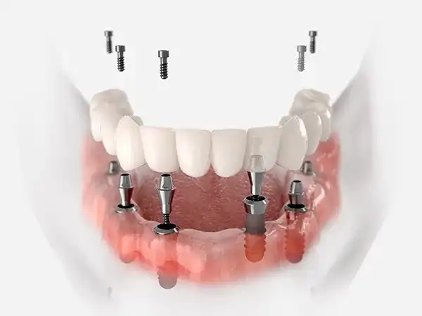 Full-Mouth Fixed Implants (PMMA)